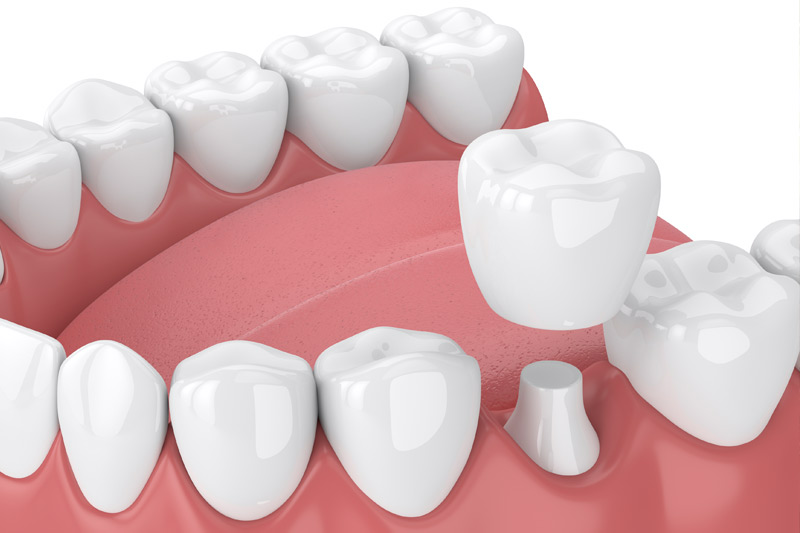 Dental Crowns in Sunnyvale