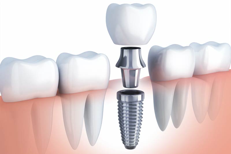 Implants Dentist in Sunnyvale