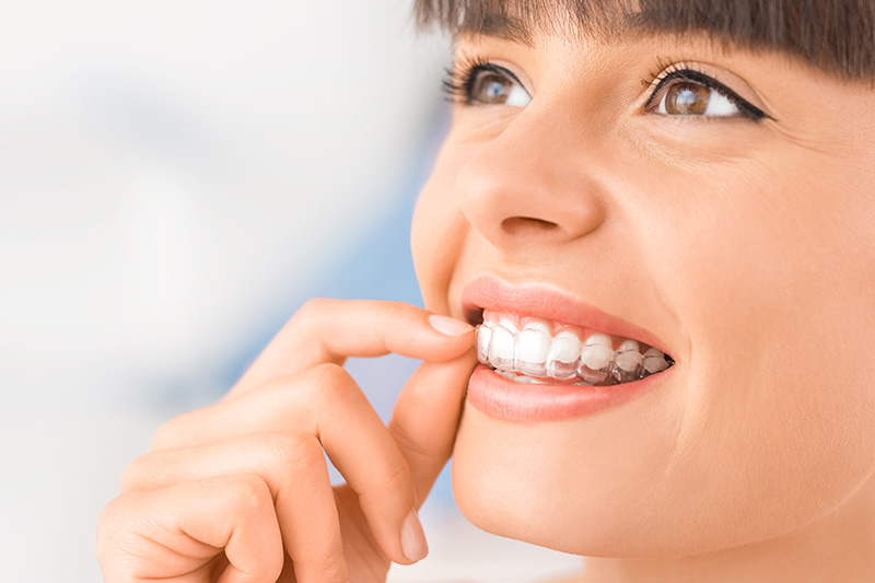 Invisalign in Sunnyvale