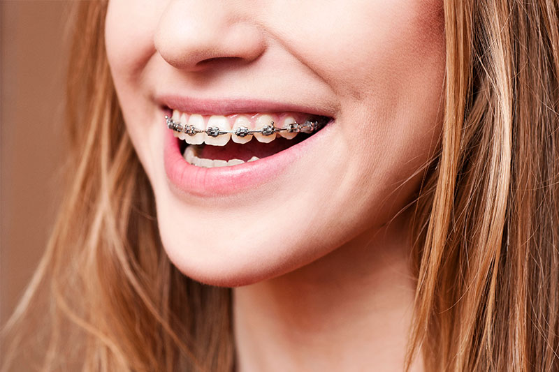 Orthodontics in Sunnyvale