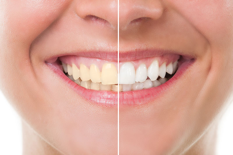 Teeth Whitening in Sunnyvale