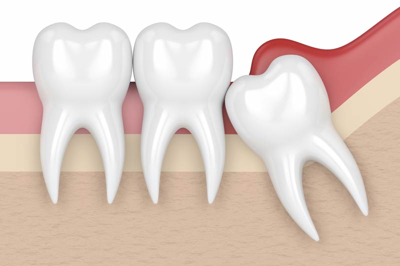 Wisdom Tooth Removal in Sunnyvale